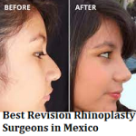 Best Revision Rhinoplasty Surgeons in Mexico