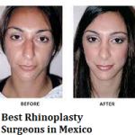 Best Rhinoplasty Surgeons in Mexico