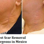 Best Scar Removal Surgeons in Mexico