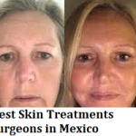 Best Skin Treatments Surgeons in Mexico