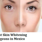 Best Skin Whitening Surgeons in Mexico