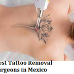 Best Tattoo Removal Surgeons in Mexico