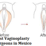 Best Vaginoplasty Surgeons in Mexico