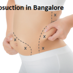Liposuction Surgery in Bangalore