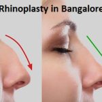 Rhinoplasty-Surgery-In-Bangalore