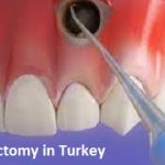 Apicoectomy in Turkey