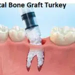 Dental Bone Grating in Turkey