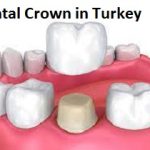 Dental Crown in Turkey