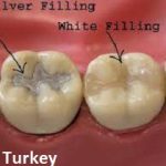 Dental Filling in Turkey