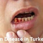 Gum Disease in Turkey