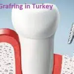 Gum Grafting in Turkey