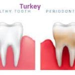 Periodontitis Dental Surgery in Turkey