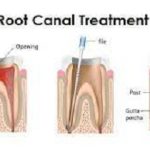 Root Canal treatment cost in Turkey