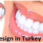 Smile Design in Turkey