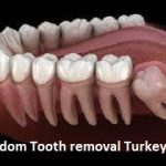 Wisdom Tooth Removal in Turkey