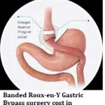 Banded Roux-en-Y Gastric Bypass surgery cost in Mexico