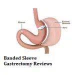 Banded Sleeve Gastrectomy Reviews