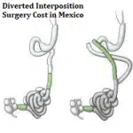 Diverted Interposition Surgery Cost in Mexico