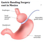 Gastric Banding Surgery cost in Mexico