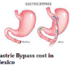 Gastric Bypass cost in Mexico