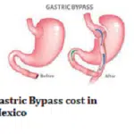 Gastric Bypass cost in Mexico