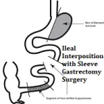 Ileal Interposition with Sleeve Gastrectomy Surgery cost in Mexico