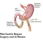 Mini Gastric Bypass Surgery cost in Mexico