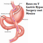 Roux-en-Y Gastric Bypass Surgery Cost in Mexico