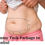 Tummy Tuck Package in Istanbul