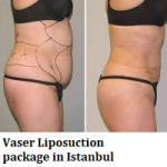 Vaser Liposuction package in Istanbul