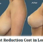 Breast Reduction Cost in London
