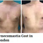 Gynecomastia Cost in London