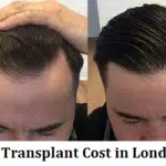 Hair Transplant Cost in London