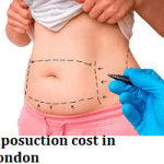 Liposuction cost in London