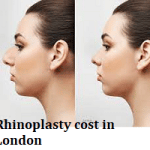 Rhinoplasty cost in London