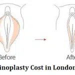 Vaginoplasty Cost in London