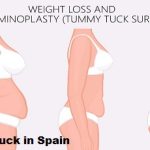 Tummy Tuck in Spain