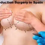 Breast Reduction Surgery in Spain