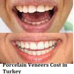 Porcelain Veneers Cost in Turkey