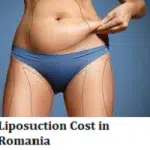 Liposuction Cost in Romania