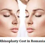 Rhinoplasty Cost in Romania