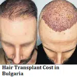 Hair Transplant Cost in Bulgaria